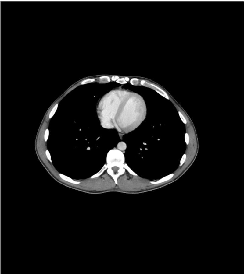 Example thorax CT scan showing lung anatomy